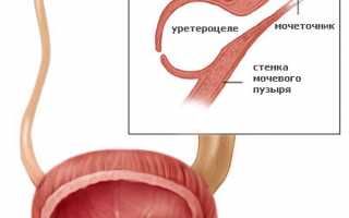 Уретероцеле — виды порока и тактика лечения