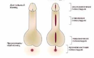 Гипоспадия у мальчиков — как проявляется и что с этим делать?