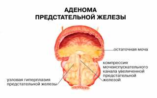 Как происходит воспаление простаты?