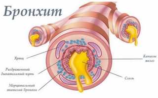Из-за чего бывает гнойный бронхит и как его вылечить