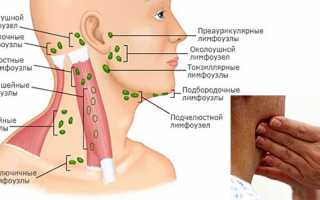 Что делать, если воспалился лимфоузел на шее: причины, клинические проявления, методы лечения, профилактика