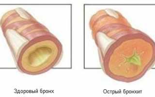 Сколько держится температура при бронхите у детей и как ее сбивать