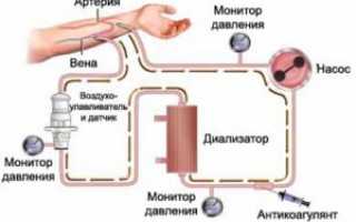 Фистула для гемодиализа — виды и значение