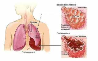 Характерные признаки по которым можно бронхит отличить от пневмонии