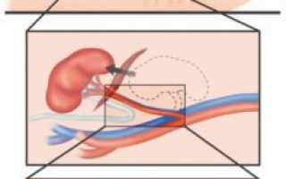 Нефрэктомия — виды, показания и послеоперационный период