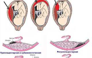 Что это такое ретрохориальная гематома при беременности образовавшаяся на ранних сроках и как можно вылечить