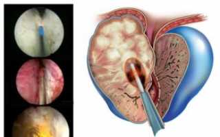 Когда необходимо удаление аденомы простаты лазерным методом?