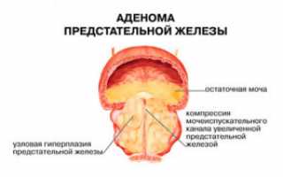 Признаки простатита после 35 лет — что делать?