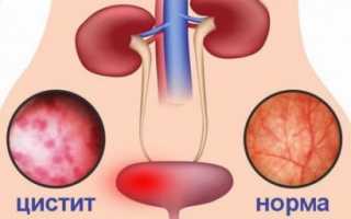 Цистит: причины, осложнения, терапия