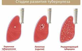 Способы лечения устойчивого туберкулеза