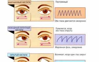 Нистагм — бегающий глаз