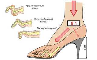 Лечение плоскостопия у взрослых