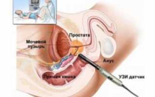 Подготовка к УЗИ аденомы простаты — какие виды обследований существуют?