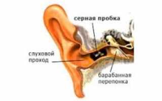 Что делать, если в ухе пробка?