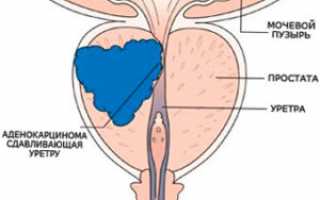 Аденокарцинома предстательной железы — как проводится лечение?