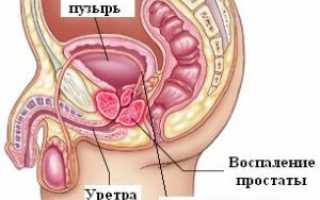 Какими могут быть выделения при простатите?