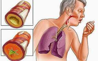Секреты успешного лечения запущенного бронхита