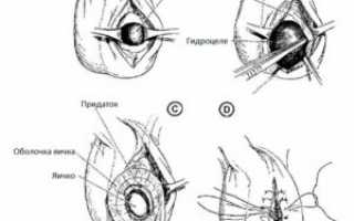 Как проводится операция гидроцеле (водянка яичка) у взрослых и детей?