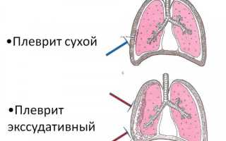 Что за заболевание туберкулезный плеврит