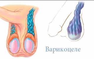 Отек мошонки у мужчин