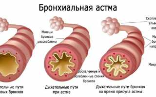 7 симптомов бронхита у взрослых без температуры