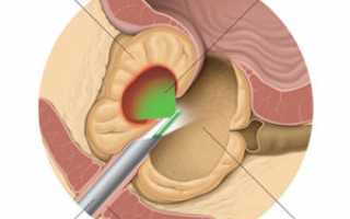 Как происходит удаление аденомы предстательной железы?