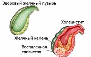 Что это такое водянка желчного пузыря, основные причины образования и методы лечения