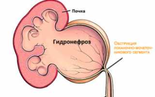 Как правильно лечить гидронефроз?