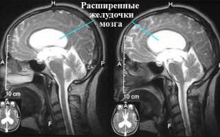 Причины увеличения, расширения и отека у новорожденного желудочков головного мозга