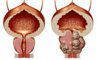 Самые главные причины появления аденомы простаты