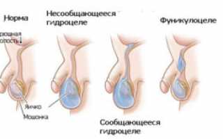 Опасна ли водянка яичка у новорожденного ребенка?