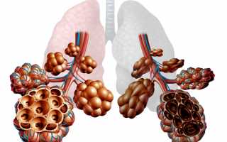 Эмфизема легких: все о патологии и ее лечении