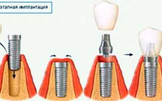 Процесс имплантации зубов