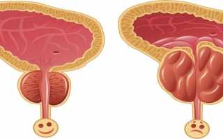 На что обычно жалуются при простатите и аденоме простаты?