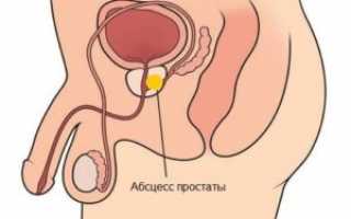 Главные особенности Абсцесса простаты