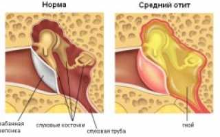 Причины возникновения острого отита у детей и его лечение