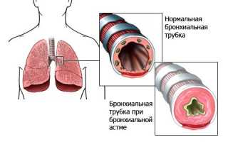 Какие осложнения может вызвать бронхиальная астма в организме