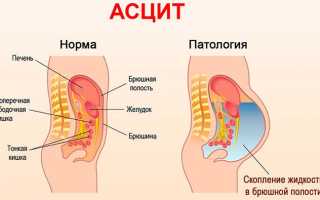 Лечение асцита брюшной полости при сердечной недостаточности и дальнейший прогноз