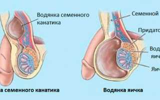 Водянка яичка у мужчин – почему происходит и что делать?