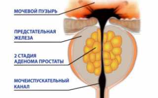 Почему появляется кровь в моче при аденоме простаты?