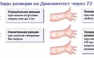 Какая норма у детей по тесту Диаскинтест и как расшифровать результаты