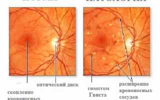 Ангиопатия: поражение сетчатки обоих глаз, как лечить