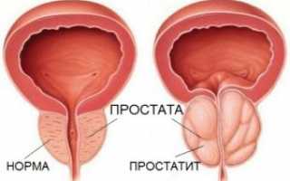 Почему в молодом возрасте появляется простатит?