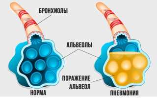 Симптомы отека легких, а так же причины, лечение и последствия