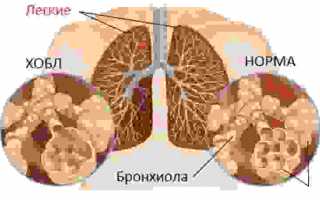 Насколько эффективен АЦЦ при бронхите